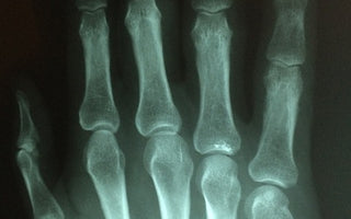 broken finger